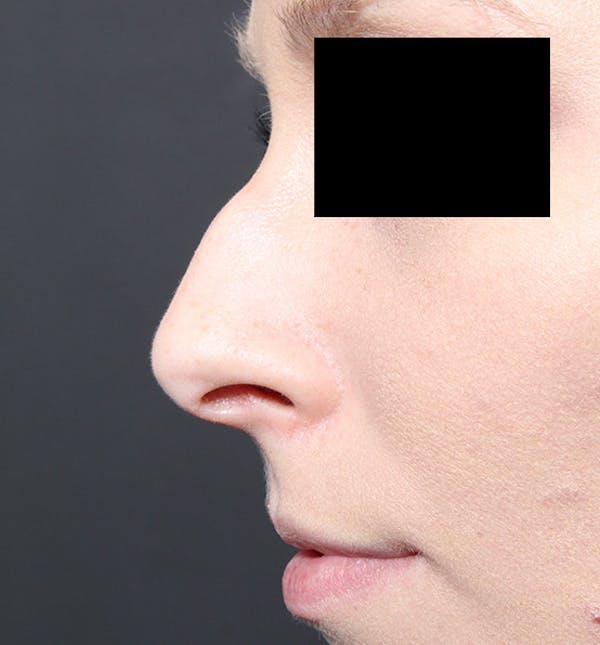 Rhinoplasty Before & After Gallery - Patient 14089562 - Image 5