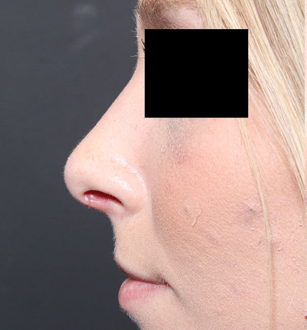 Rhinoplasty Before & After Gallery - Patient 14089562 - Image 6