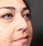 Non-Surgical Rhinoplasty Before & After Gallery - Patient 14089567 - Image 1