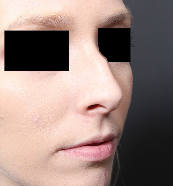 Rhinoplasty Before & After Gallery - Patient 14089562 - Image 7