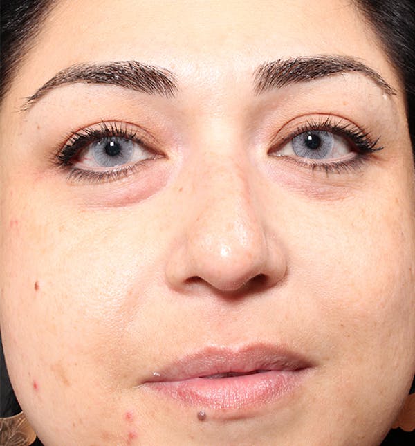 Non-Surgical Rhinoplasty Before & After Gallery - Patient 14089567 - Image 3
