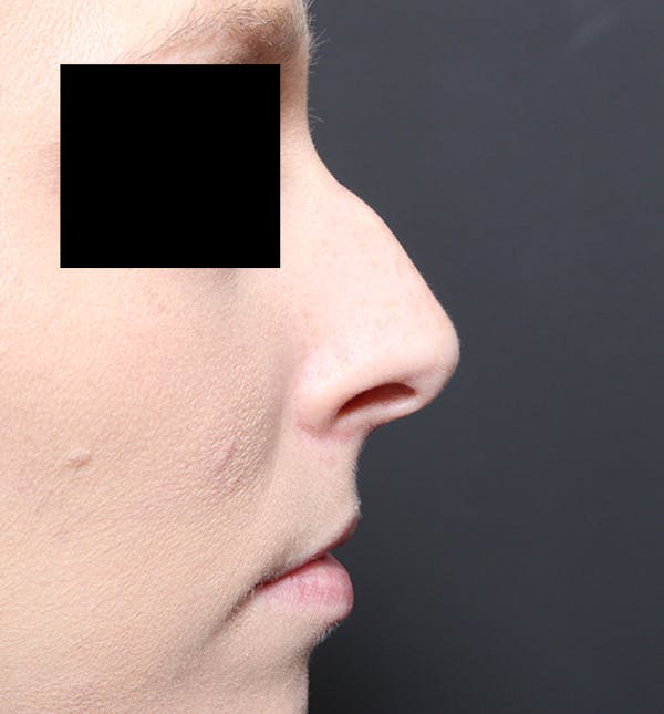 Rhinoplasty Before & After Gallery - Patient 14089562 - Image 9