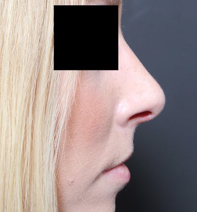 Rhinoplasty Before & After Gallery - Patient 14089562 - Image 10
