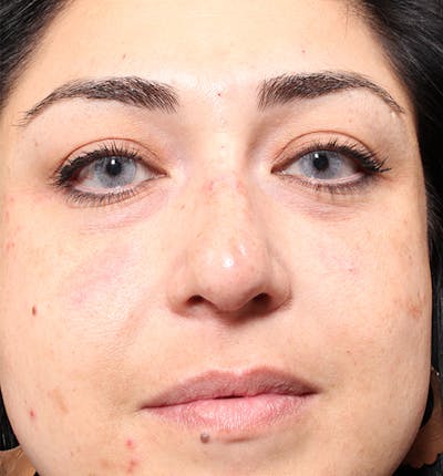 Non-Surgical Rhinoplasty Before & After Gallery - Patient 14089567 - Image 4