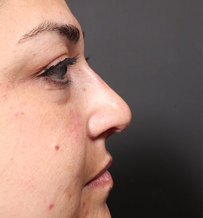Non-Surgical Rhinoplasty Gallery - Patient 14089567 - Image 6