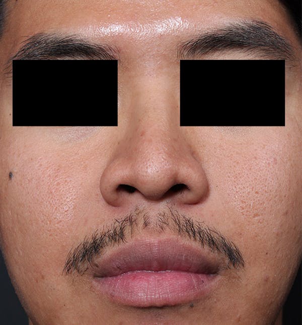 Rhinoplasty Before & After Gallery - Patient 14089570 - Image 3