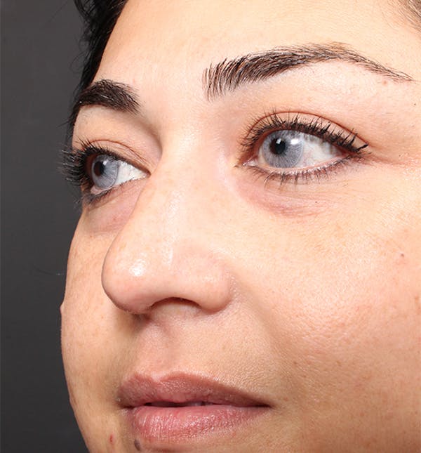 Non-Surgical Rhinoplasty Before & After Gallery - Patient 14089567 - Image 7