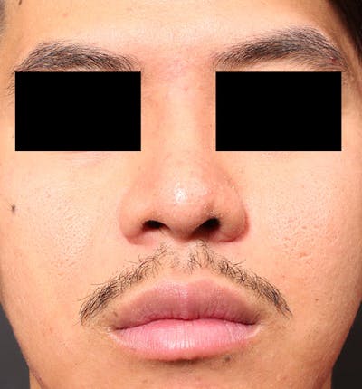 Rhinoplasty Before & After Gallery - Patient 14089570 - Image 4