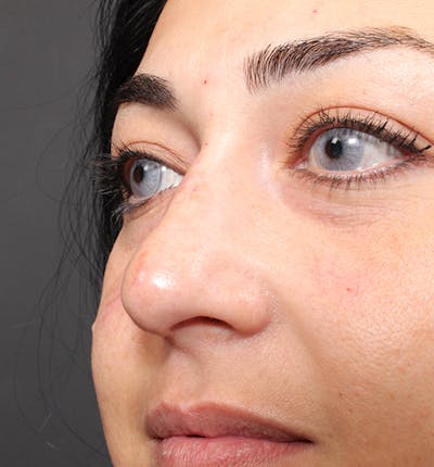 Non-Surgical Rhinoplasty Before & After Gallery - Patient 14089567 - Image 8