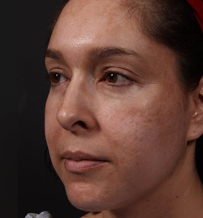 Fat Transfer Before & After Gallery - Patient 14089569 - Image 1