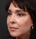Fat Transfer Before & After Gallery - Patient 14089569 - Image 2