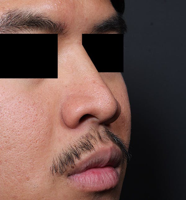 Rhinoplasty Before & After Gallery - Patient 14089570 - Image 7
