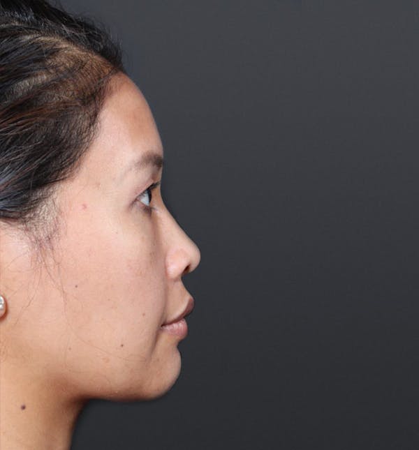 Genioplasty Before & After Gallery - Patient 14089577 - Image 1