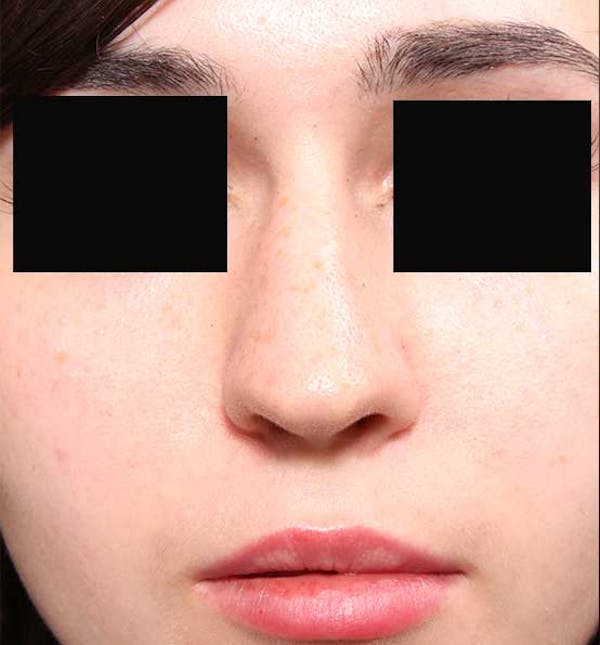 Non-Surgical Rhinoplasty Before & After Gallery - Patient 14089574 - Image 3