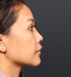 Genioplasty Before & After Gallery - Patient 14089577 - Image 2