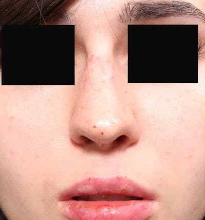 Non-Surgical Rhinoplasty Before & After Gallery - Patient 14089574 - Image 4