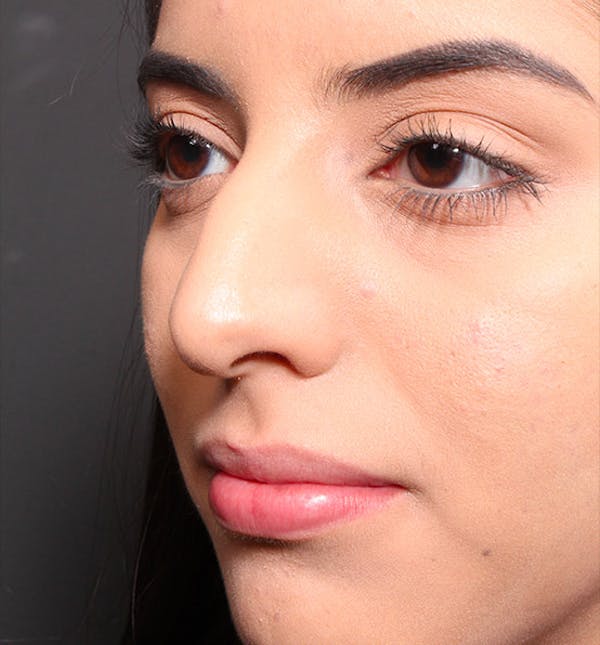 Rhinoplasty Before & After Gallery - Patient 14089575 - Image 1
