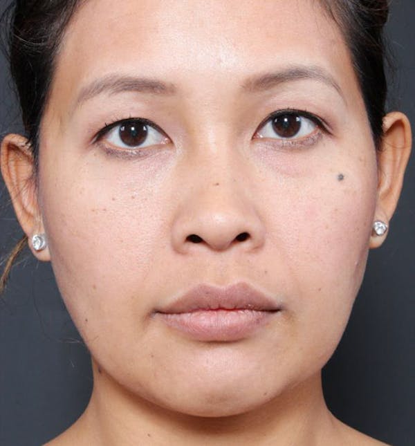 Genioplasty Before & After Gallery - Patient 14089577 - Image 3
