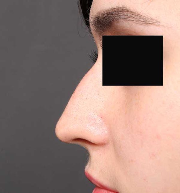 Non-Surgical Rhinoplasty Before & After Gallery - Patient 14089574 - Image 5