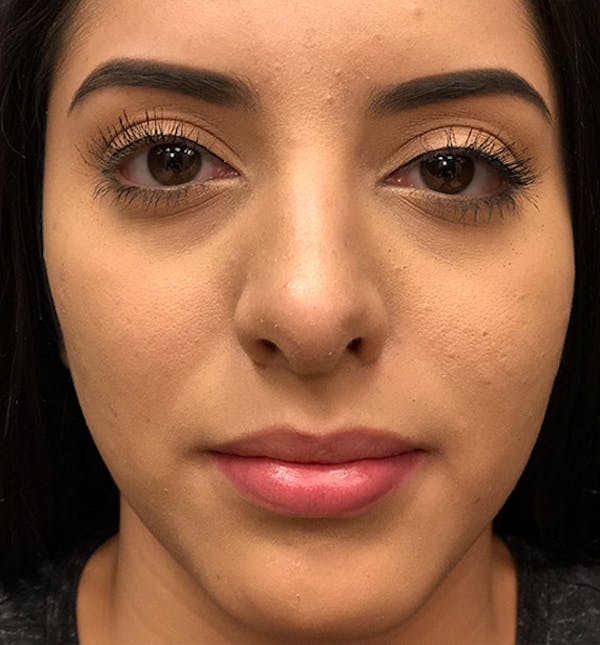 Rhinoplasty Before & After Gallery - Patient 14089575 - Image 4