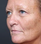 Fat Transfer Before & After Gallery - Patient 14089579 - Image 1
