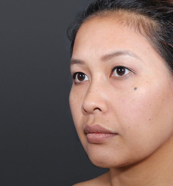 Genioplasty Before & After Gallery - Patient 14089577 - Image 9