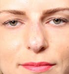 Non-Surgical Rhinoplasty Before & After Gallery - Patient 14089581 - Image 2