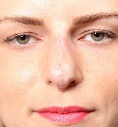 Non-Surgical Rhinoplasty Before & After Gallery - Patient 14089581 - Image 2