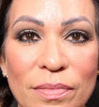 Eyelid Lift Before & After Gallery - Patient 14089576 - Image 2