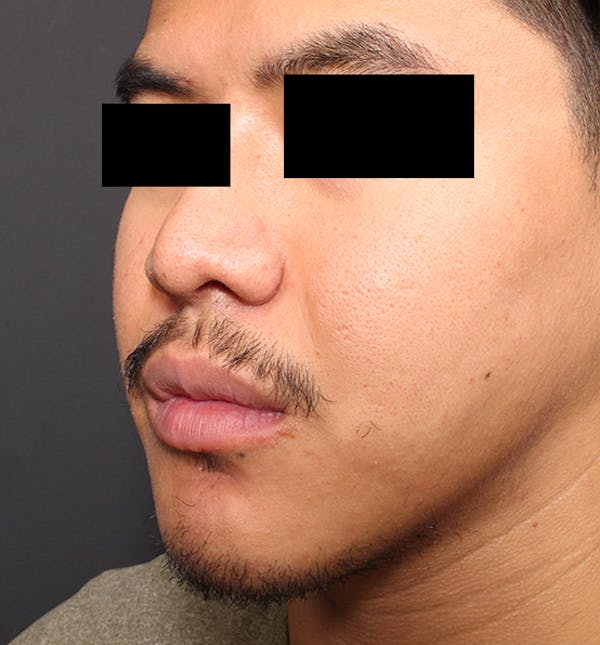 Genioplasty Before & After Gallery - Patient 14089584 - Image 2