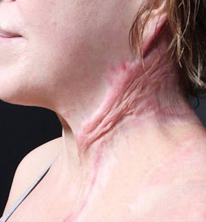 Facial Reconstruction