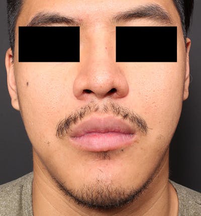Genioplasty Before & After Gallery - Patient 14089584 - Image 4