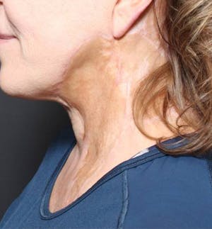 Facial Reconstruction