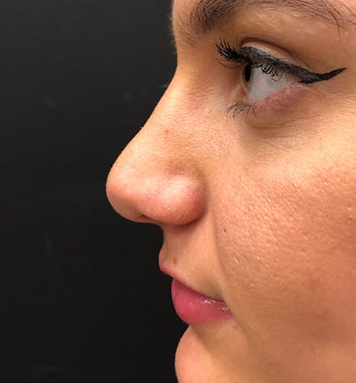 Rhinoplasty Before & After Gallery - Patient 14089580 - Image 6