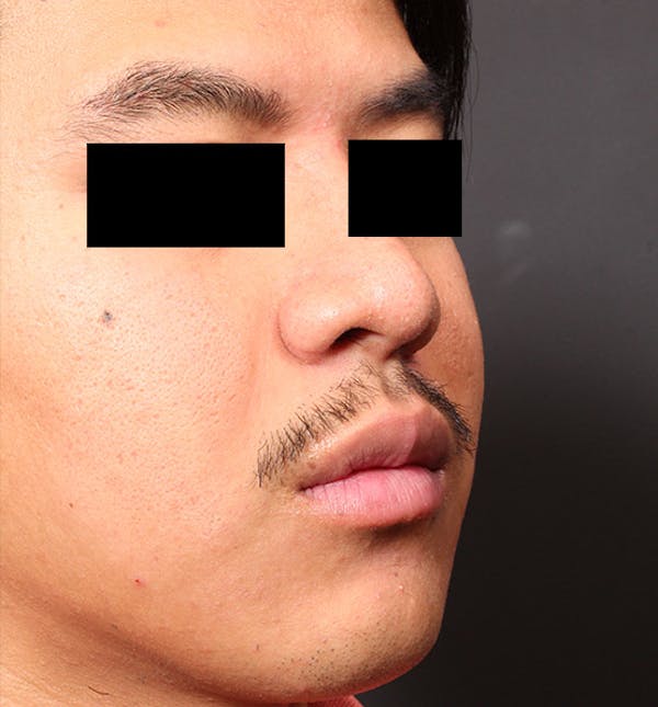 Genioplasty Before & After Gallery - Patient 14089584 - Image 7