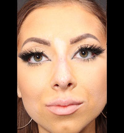 Non-Surgical Rhinoplasty Before & After Gallery - Patient 14089586 - Image 4