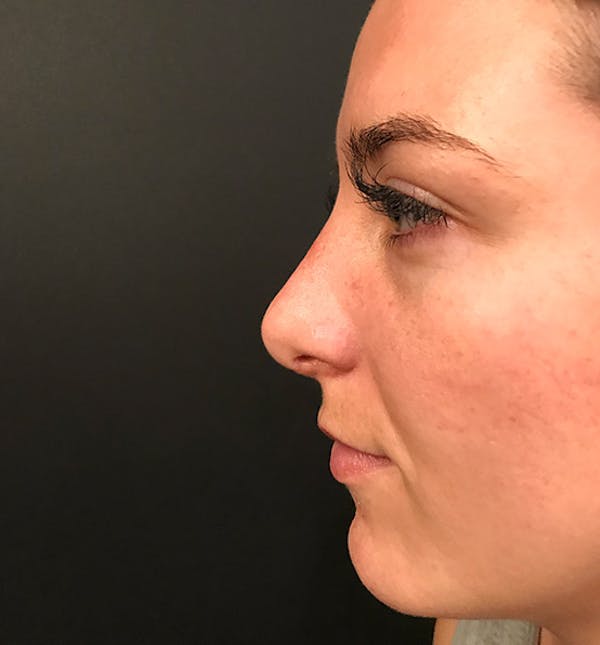 Rhinoplasty Before & After Gallery - Patient 14089585 - Image 6