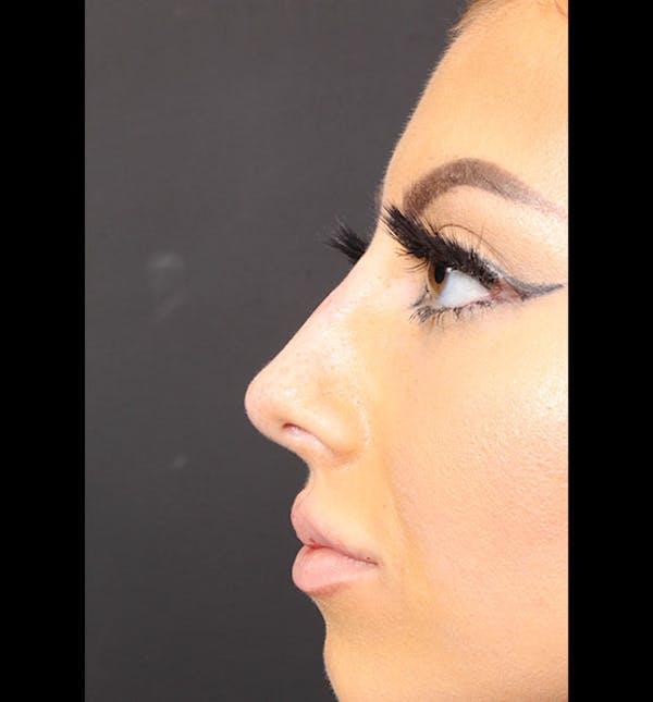 Non-Surgical Rhinoplasty Gallery - Patient 14089586 - Image 6