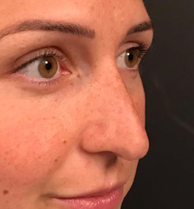 Rhinoplasty Before & After Gallery - Patient 14089588 - Image 1