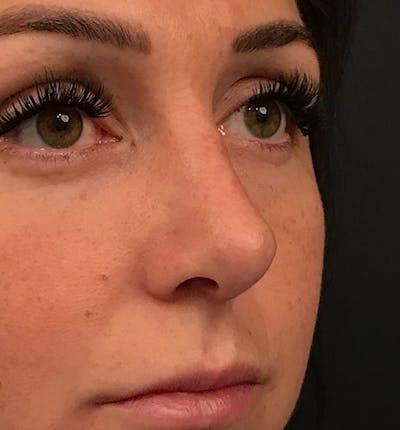 Rhinoplasty Before & After Gallery - Patient 14089588 - Image 2