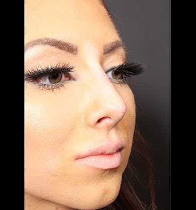 Non-Surgical Rhinoplasty Before & After Gallery - Patient 14089586 - Image 8