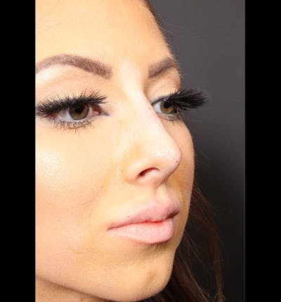 Non-Surgical Rhinoplasty Before & After Gallery - Patient 14089586 - Image 8