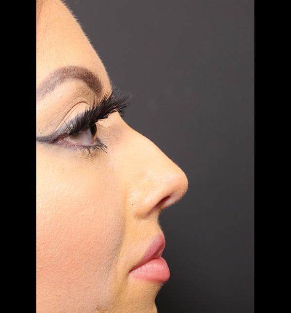 Non-Surgical Rhinoplasty Before & After Gallery - Patient 14089586 - Image 9