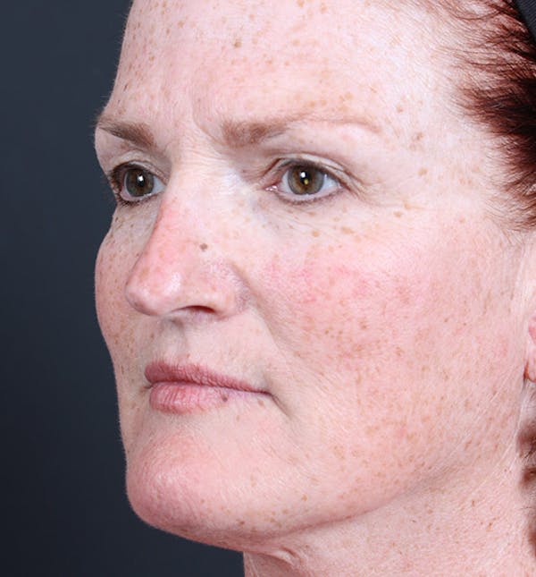 Non-Surgical Skin Resurfacing Before & After Gallery - Patient 14089589 - Image 1