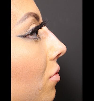 Non-Surgical Rhinoplasty Before & After Gallery - Patient 14089586 - Image 10