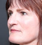 Non-Surgical Skin Resurfacing Before & After Gallery - Patient 14089589 - Image 2