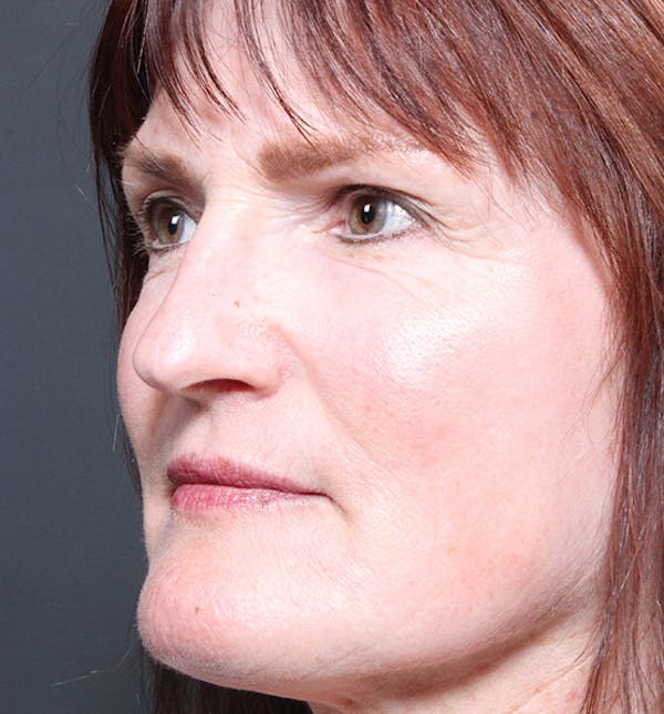 Non-Surgical Skin Resurfacing Gallery - Patient 14089589 - Image 2