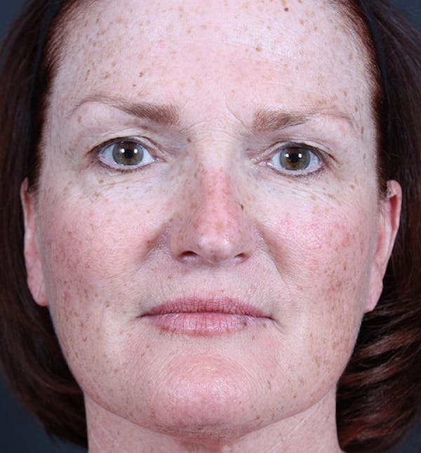 Non-Surgical Skin Resurfacing Before & After Gallery - Patient 14089589 - Image 3