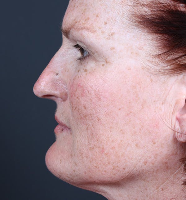 Non-Surgical Skin Resurfacing Before & After Gallery - Patient 14089589 - Image 5