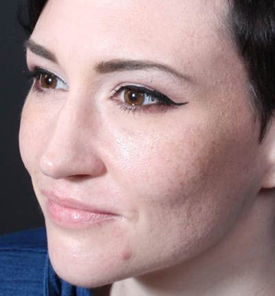 Injectables Before & After Gallery - Patient 14089592 - Image 1